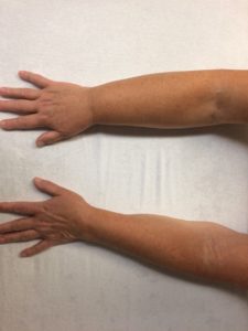 arm lymphedema